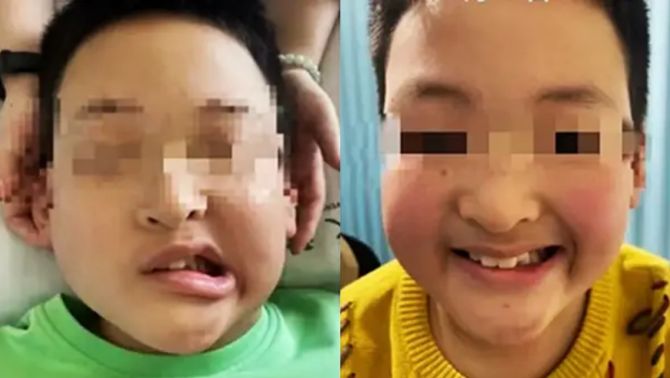 Bé trai 11 tuổi bỗng méo miệng sau một đêm: Bác sĩ tiết lộ nguyên nhân khiến nhiều phụ huynh giật mình