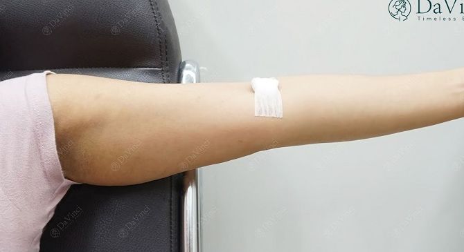 Giải Mã Công Nghệ Rút Mỡ Đối Khí Âm Tần: Vì sao Tỷ Lệ Sống Mỡ Tự Thân Vượt Trội