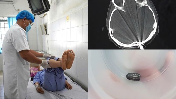 Phép màu xuất hiện với người phụ nữ đang làm vườn bị đạn bay trúng đầu, hé lộ tình hình hiện tại