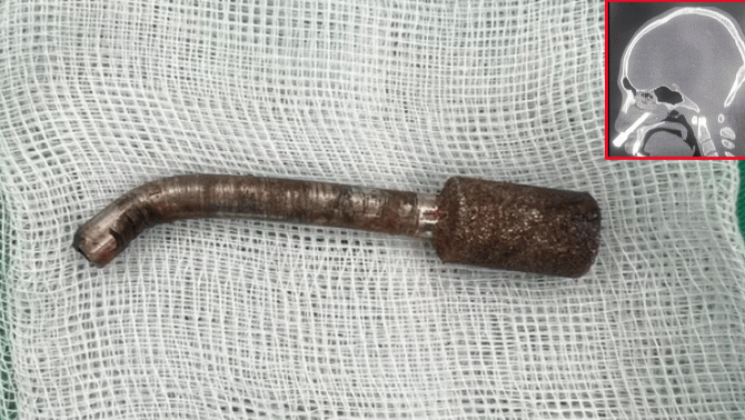 Ám ảnh cảnh nam thanh niên bị mũi khoan dài 8cm đâm xuyên hốc mũi, tình hình hiện tại của bệnh nhân ra sao?