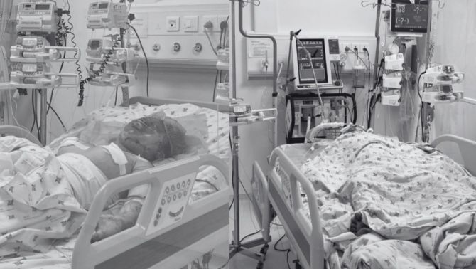 Xót xa tình hình của hai chị em bị cha ruột tưới xăng phóng hỏa khi đang ngủ, 1 em tiên lượng xấu