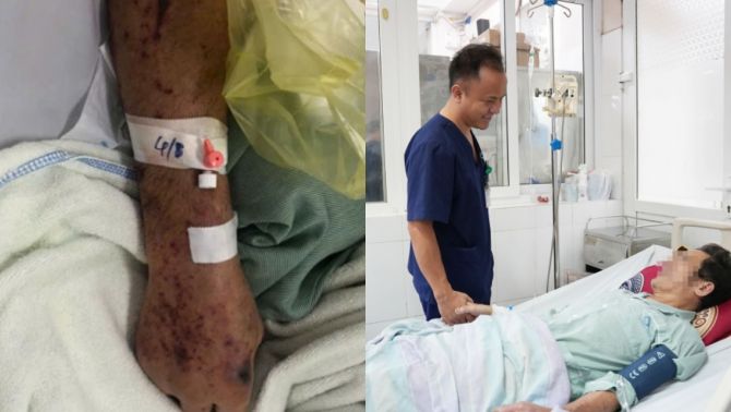 Người đàn ông Hưng Yên suýt tử vong sau khi chế biến thịt lợn sống: Bác sĩ cảnh báo hiểm họa từ liên cầu khuẩn lợn