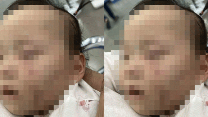 Bắc Ninh: Thông tin nóng vụ bé gái bầm tím mặt, có vết răng cắn sau khi đi học mầm non tư thục