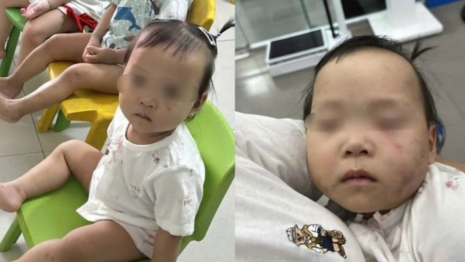 Tình hình sức khoẻ bé gái 1 tuổi tím tái mặt mũi sau buổi đầu đến lớp ở Bắc Ninh: Cơ quan chức năng nói gì?