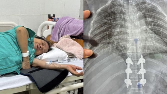 Tìm tài xế xe máy đâm bà lão ở Buôn Ma Thuột rồi bỏ trốn: Nạn nhân gãy 3 đốt sống, chưa có tiền phẫu thuật