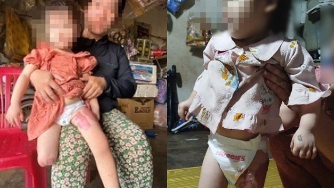 Diễn biến mới vụ xe tải cuốn cháu bé 3 tuổi hỏng 2 chân ở Gia Lai: Công an xem xét lại đơn kiến nghị