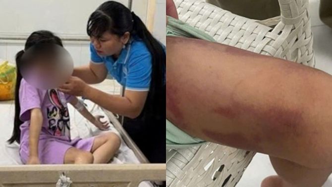 Tạm giữ mẹ ruột 25 tuổi và bạn trai 19 tuổi đánh đập cháu bé ở TP.HCM đến mức phải nhập viện