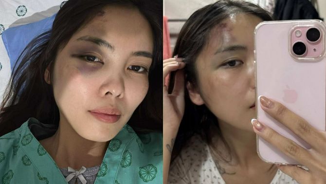 Người vợ bị chồng đánh chấn động não hé lộ tình tiết phẫn nộ, vợ cũ ra mặt vạch trần bản chất người đàn ông