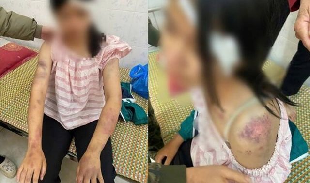 Tình hình sức khỏe của bé gái bị bà nội và người thân bạo hành dã man vì nghi ăn trộm tiền