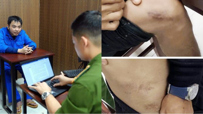 Rùng mình quá trình cựu nhân viên y tế tự đục vỡ xương để trục lợi bảo hiểm, hành vi quá man rợ