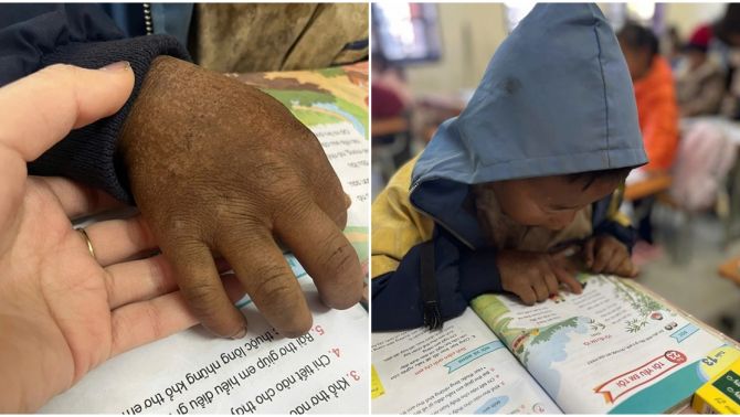 Câu chuyện xúc động đằng sau bức ảnh bàn tay sạm đen, nứt nẻ của em bé 8 tuổi ở vùng cao