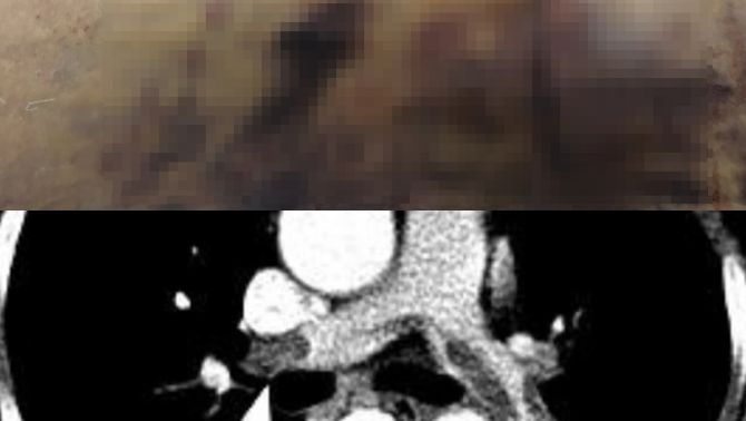 Sau 48 giờ phẫu thuật hút mỡ và nâng ngực, một nữ Việt kiều 60 tuổi tử vong: Hé lộ nguyên nhân