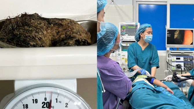 Bé gái 6 tuổi ở Quảng Ngãi nuốt nửa cân tóc, bác sĩ chuẩn đoán hội chứng hiếm gặp