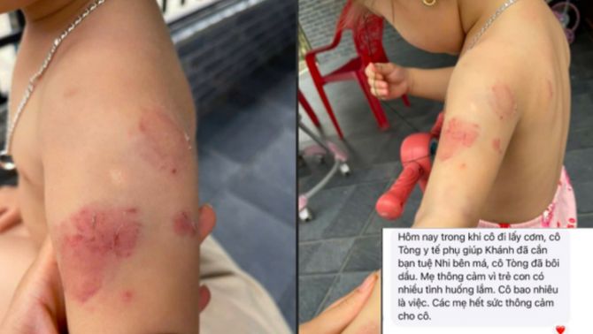 Bé hơn 2 tuổi chi chít vết bầm tím sau giờ học, lời giải thích gây tranh cãi từ giáo viên mầm non và nhà trường
