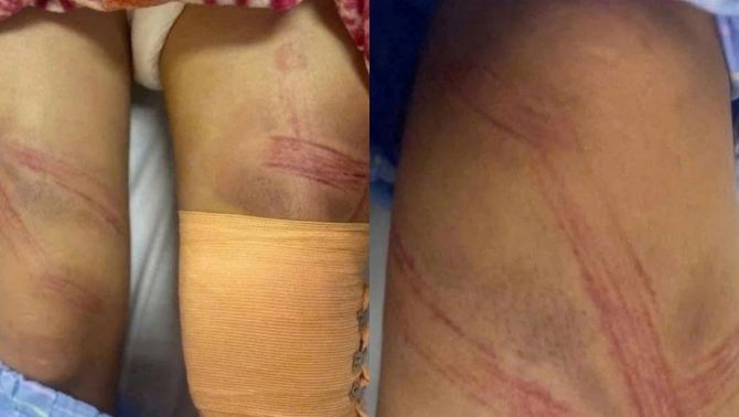 Thông tin nóng vụ nữ sinh lớp 7 nhập viện với nhiều vết bầm: Bất ngờ với lời khai của người bố