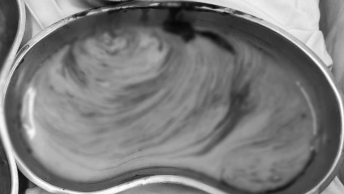 Người phụ nữ tiêm filler vùng mông gặp biến chứng sau nhiều năm, bác sĩ hút 3 lít dịch mủ, tình trạng hiện tại ám ảnh