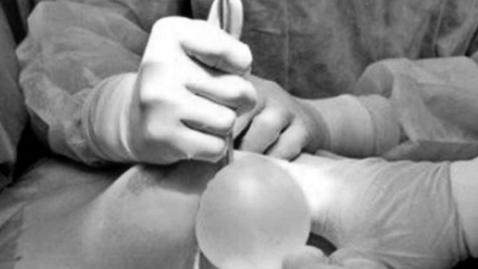 Tiêm filler nâng ngực, người phụ nữ 30 tuổi nhập viện vì hoại tử nặng, bác sĩ cảnh báo nguy hiểm từ làm đẹp giá rẻ