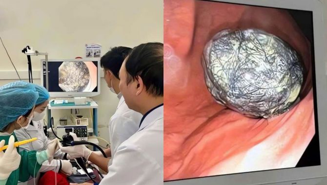 Quảng Ninh: Bé gái 5 tuổi suy dinh dưỡng nặng, chỉ 13kg, bác sĩ phát hiện búi tóc lớn trong dạ dày