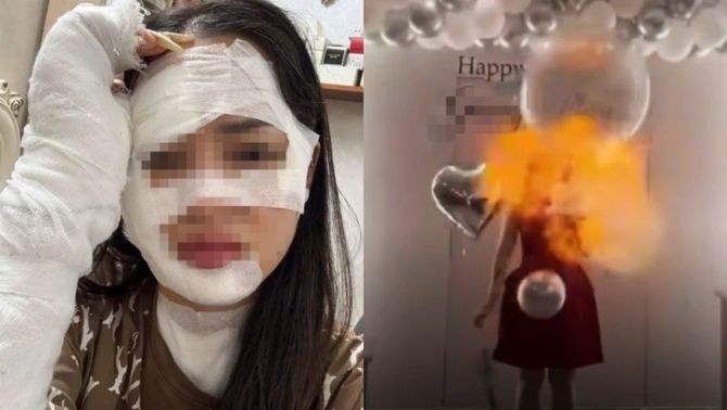 Tình trạng sức khỏe và diện mạo hiện tại của cô gái bị bỏng nặng do bóng bay sinh nhật phát nổ