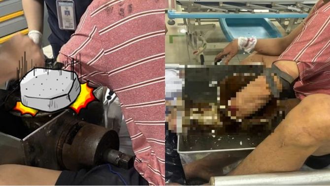 TP.HCM: Nam công nhân bị cuốn cả cánh tay vào máy xay thịt, ám ảnh tình trạng khi nhập viện cấp cứu