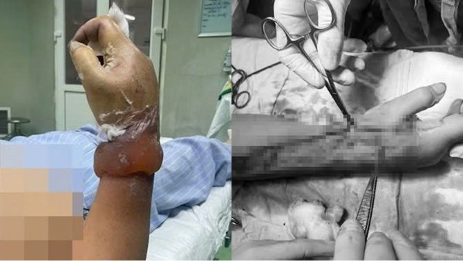 Lý do 2 vợ chồng ở Nghệ An bị điện giật khi dựng cây nêu đón Tết, 1 người nguy cơ cao cụt cẳng tay