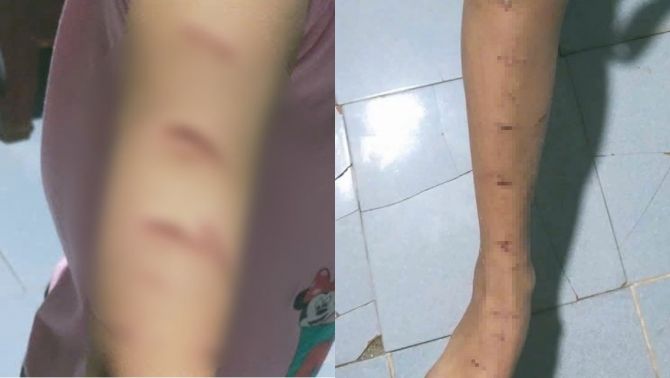 Lời khai người chị họ dùng dao rạch khắp người bé gái lớp 5, gia đình đưa ra hướng giải quyết