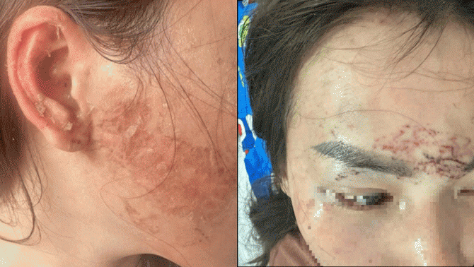 Tình tiết nóng vụ ghen tuông mù quáng, xăm lên mặt và gây thương tích nặng bồ của chồng ở Cà Mau