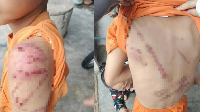 Chi chít vết bầm trên người bé trai 10 tuổi ở Đắk Lắk: Hé lộ sự thật phía sau, liên quan đến bố ruột