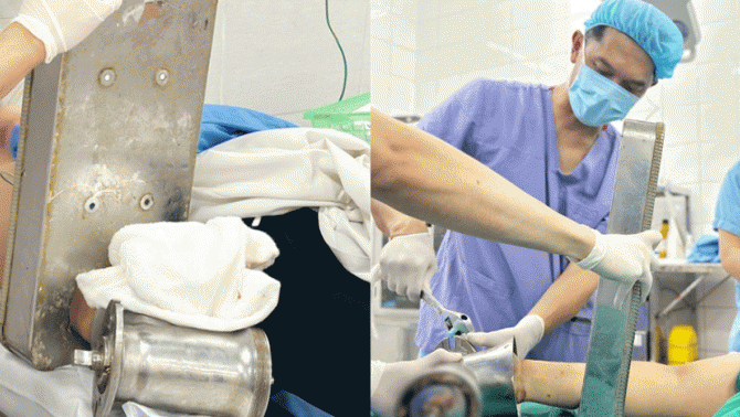 Bàn tay người phụ nữ cuốn chặt vào máy xay: Bác sĩ có quyết định khẩn để bảo vệ tính mạng bệnh nhân