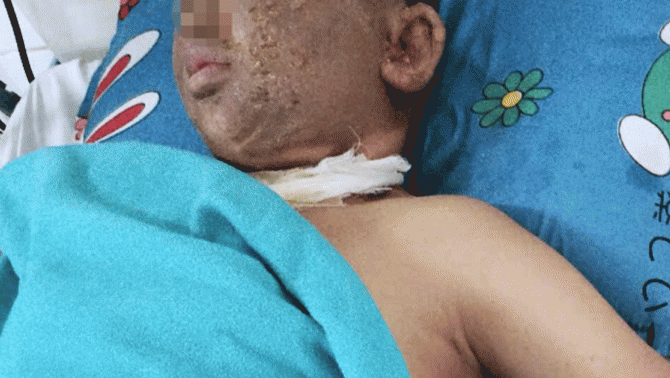 TP.HCM: Nam thanh niên mất một mắt sau khi thực hiện tục lệ quen thuộc ngày Tết, tình hình nạn nhân