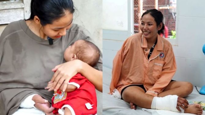 Sản phụ 18 tuổi ghép bàn tay đứt lìa vào chân hiện ra sao sau ca sinh đôi đầy nghẹt thở?