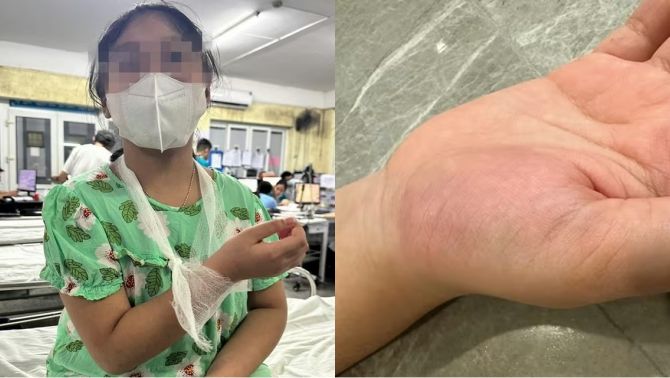 Vụ học sinh lớp 4 bị cô giáo đánh vào tay: Thông tin từ bệnh viện, giáo viên bất ngờ trước kết quả khám