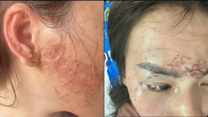 Tòa tuyên án 2 người phụ nữ ‘bắt giữ’ tình nhân của chồng rồi hành hung, đổ hóa chất và xăm lên mặt