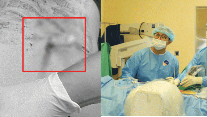 Tình trạng hiện tại của người phụ nữ cấp cứu trong tình trạng con dao Thái Lan cắm sâu trên lưng