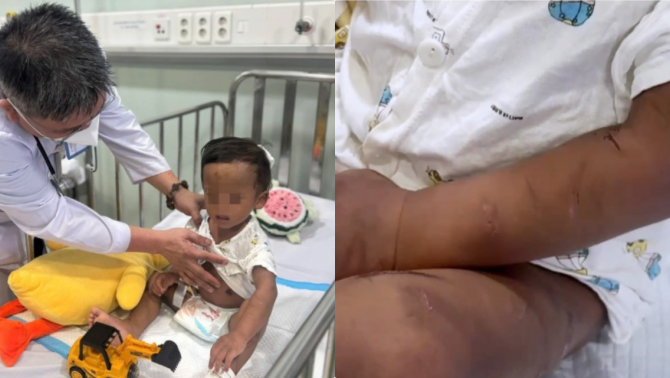 Hoàn cảnh éo le, không nơi nương tựa của bé trai 2 tuổi bị mẹ ruột và người tình bạo hành ở TP.HCM