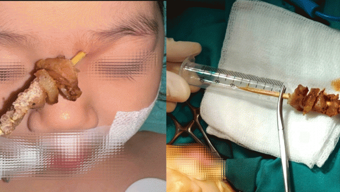 Nguyên nhân bé gái hơn 2 tuổi bị que xiên thịt nướng đâm vào hốc mắt, tình hình sức khỏe của bé?