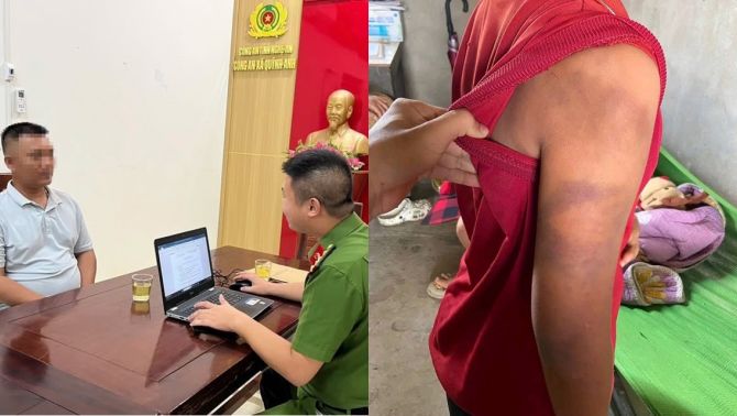 Diễn biến mới vụ mẹ cầu cứu nghi con trai bị bố ruột bạo hành sau khi ly hôn ở Nghệ An