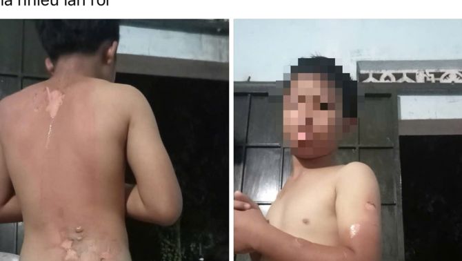 Công an thông tin vụ mẹ tạt nước sôi lên người khiến con trai bị bỏng ở Đắk Lắk 