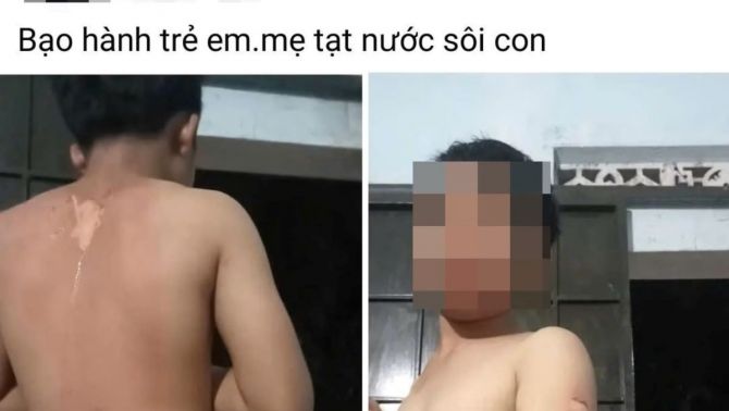 Thông tin mới vụ bé trai nghi bị mẹ ruột tạt nước sôi vào người ở Đắk Lắk