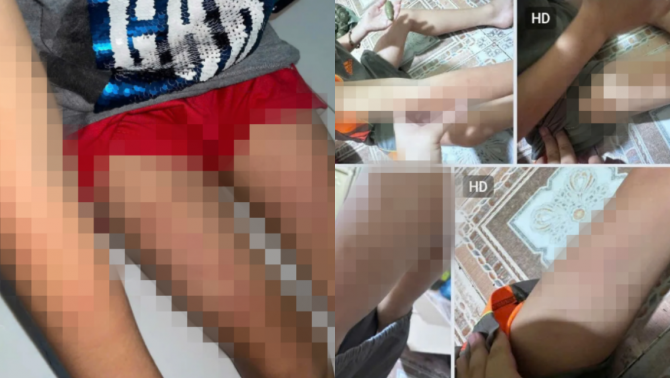 Bé trai 7 tuổi nghi bị đánh tại nhà giữ trẻ ở Khánh Hòa: Người đầy vết bầm tím, gia đình cầu cứu