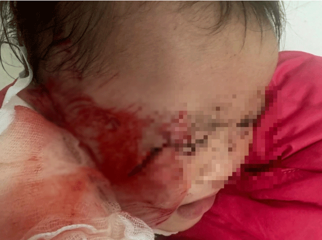 Vu-sap-tran-o-truong-de-trung-3-tre-1-be-bi-thuong-nghiem-trong-ly-do-nha-truong-chua-boi-thuong-3