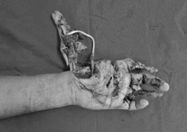 Gia-dinh-hoang-so-khi-con-trai-15-tuoi-gap-tai-nan-khi-phao-tu-che-phat-no-mat-vinh-vien-2-ngon-tay-1