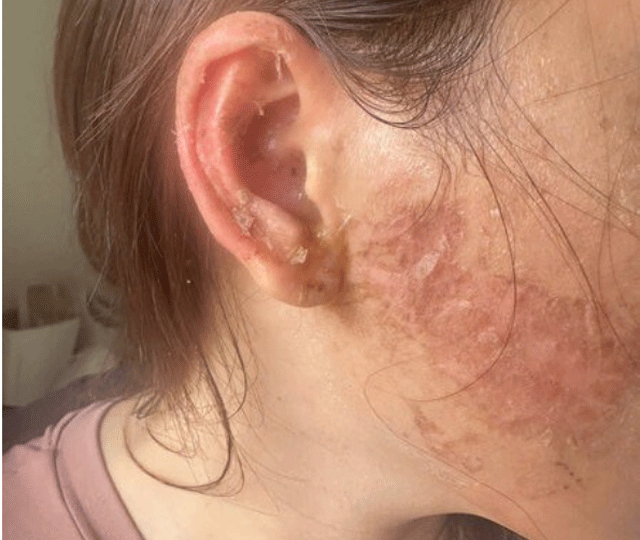 Tinh-tiet-nong-vu-ghen-tuong-mu-quang-xam-len-mat-va-gay-thuong-tich-nang-bo-cua-chong-o-ca-mau-2