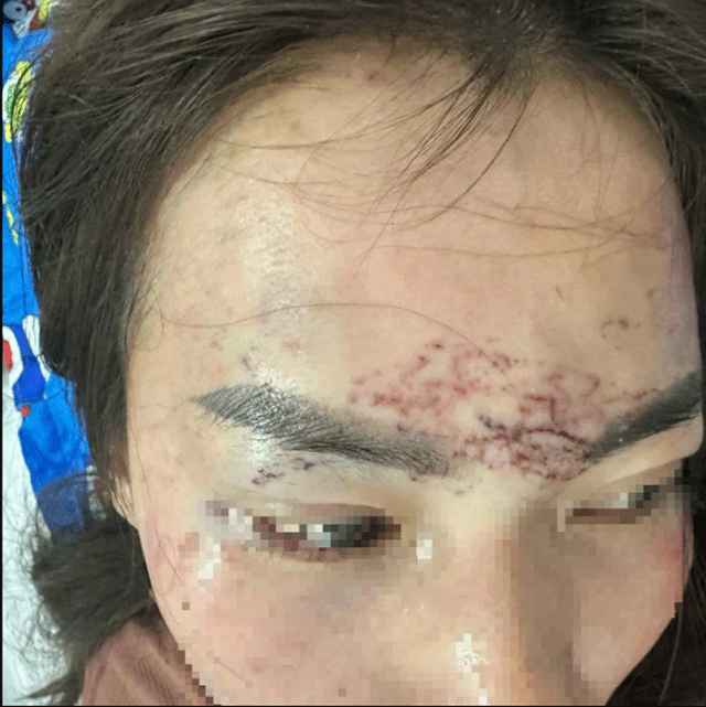 Tinh-tiet-nong-vu-ghen-tuong-mu-quang-xam-len-mat-va-gay-thuong-tich-nang-bo-cua-chong-o-ca-mau-3