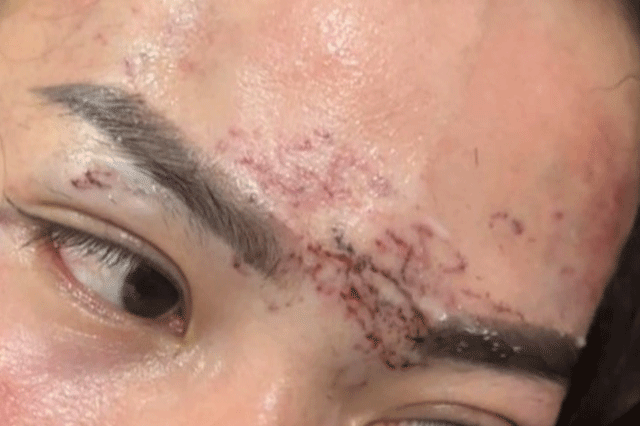 Tinh-tiet-nong-vu-ghen-tuong-mu-quang-xam-len-mat-va-gay-thuong-tich-nang-bo-cua-chong-o-ca-mau-1