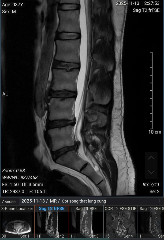 chan thuong pickleball 2