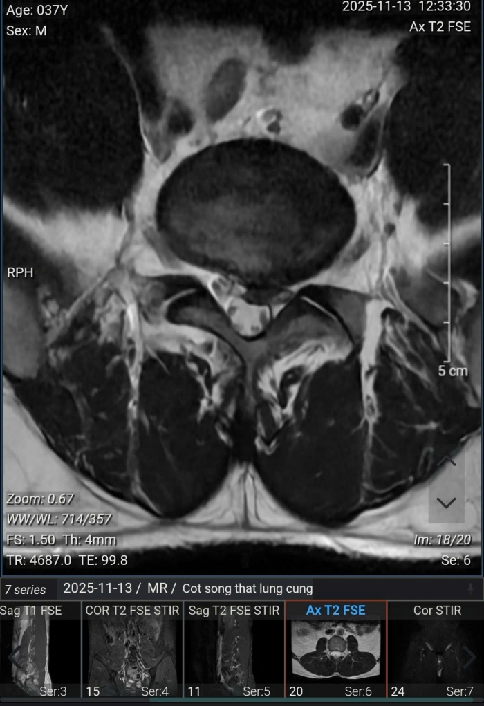 chan-thuong-pickleball1