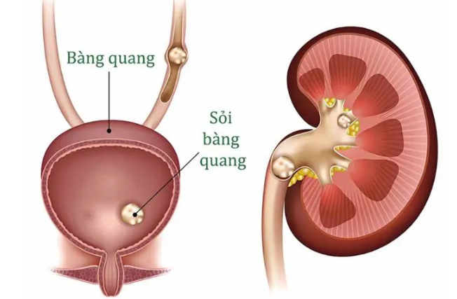 Bac-si-20-nam-trong-nghe-ngo-ngang-khi-lay-duoc-vien-soi-nang-gan-1kg-trong-bang-quang-benh-nhan