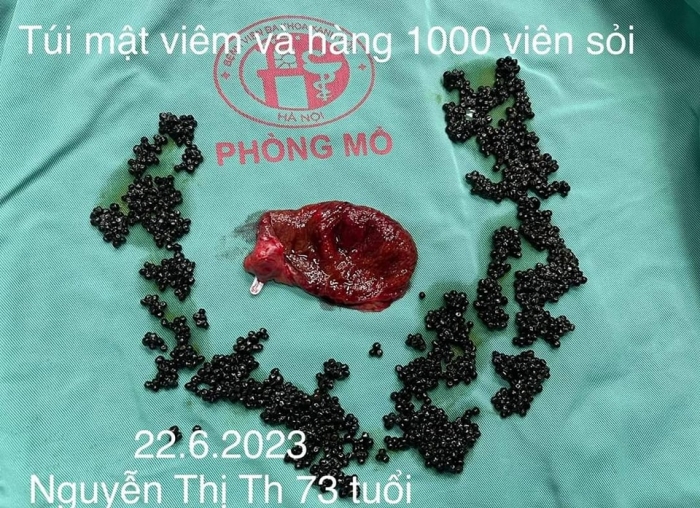 Sau nhiều ngày đau bụng quằn quại, bà cụ 73 tuổi đến khám tại bệnh viện Xanh Pôn (Hà Nội),  được chẩn đoán sỏi túi mật gây viêm và có chỉ định phẫu thuật sớm. Đáng nói, khi kết thuộc cuộc phẫu thuật trong túi mật bệnh nhân có hàng ngàn viên sỏi.