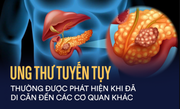 Nhung-dau-hieu-canh-bao-tiem-an-cua-benh-ung-thu-tuyen-tuy-thuong-bi-nhieu-nguoi-bo-qua-1